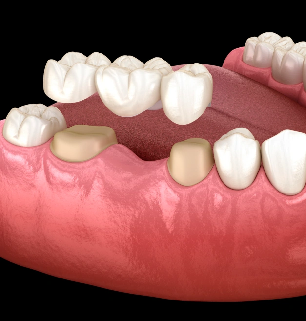 A Trusted Solution for Missing Teeth