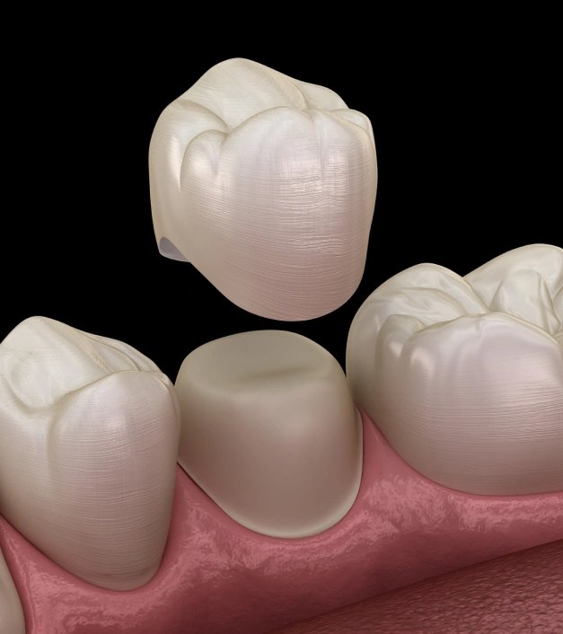 Repair Damaged Teeth with Custom Dental Crowns