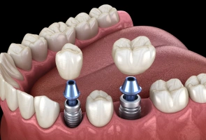 Multiple Teeth Replacement