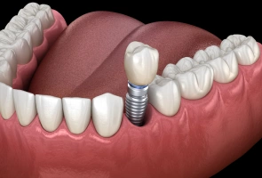 Single Tooth Replacement