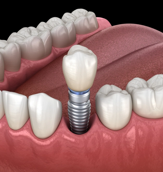 The Gold Standard in Tooth Replacement