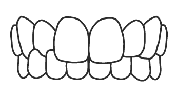Crossbite