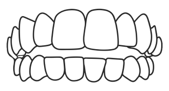 Open Bite