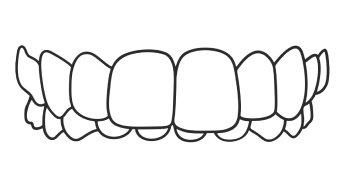 Overbite