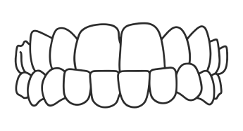 Underbite