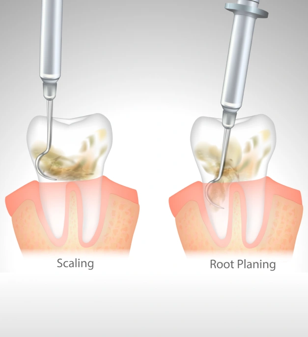 Getting to the Root of Gum Disease